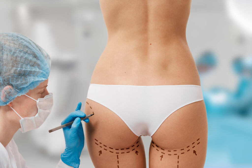 aumento-de-gluteos-con-mesoterapia